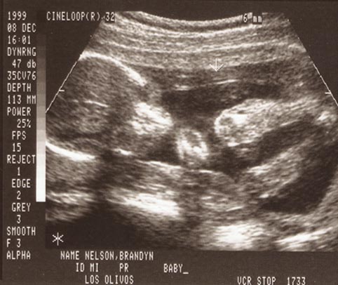 Front of baby