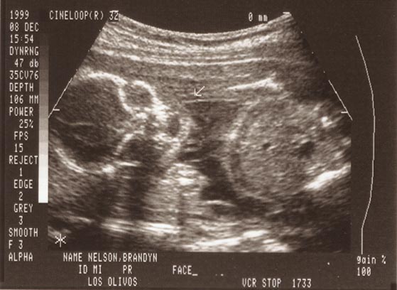 Front of baby